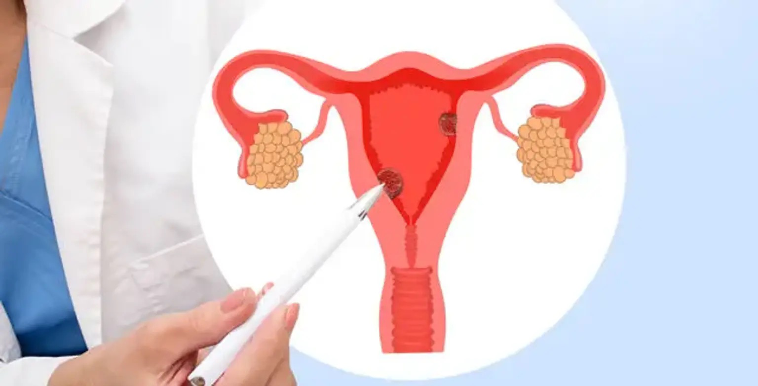 pcos