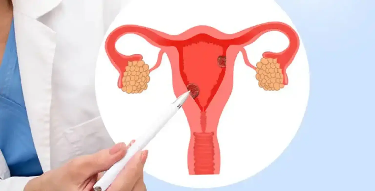 pcos