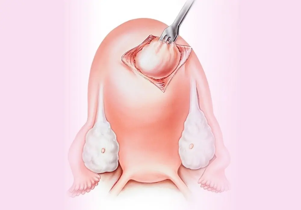 คนไข้เนื้องอกมดลูก