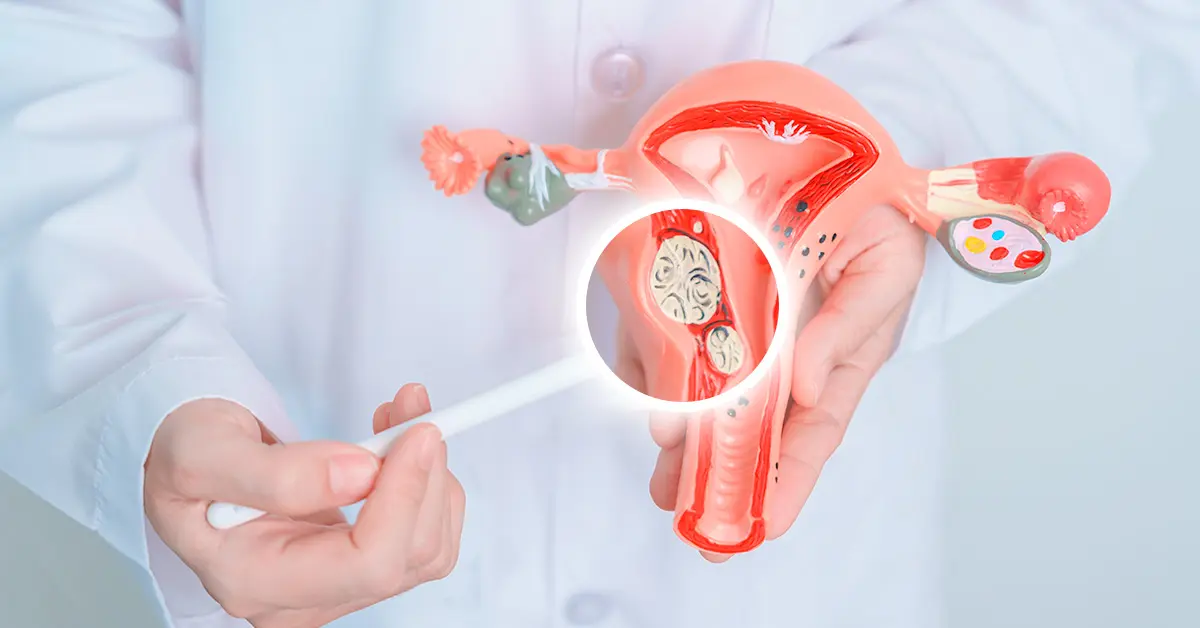 เนื้องอกมดลูก คืออะไร